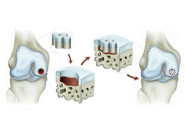 Osteochondral Autograft Transfers Knee Surgeon Minnesota