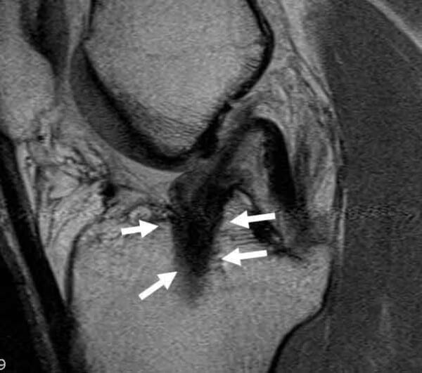 ACL Reconstruction Anterior Cruciate Ligament Surgery Knee