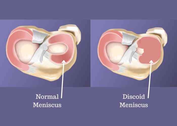 Discoid lateral store meniscus