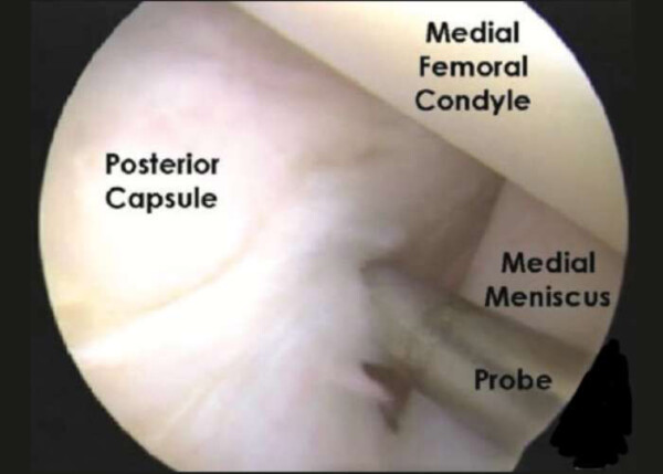 Ramp Tear in the Meniscus of the knee