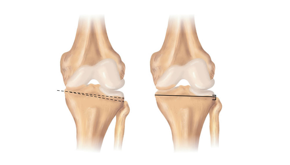ゼロからはじめる!Knee Osteotomyアップデート 日本knee Osteotomy 