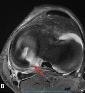 Axial MRI View of Meniscal Root Tear