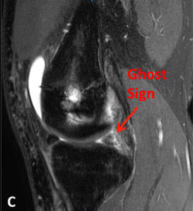 Ghost Sign Meniscal Root Tear