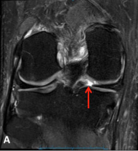 Meniscus Root Tear - Axial MRI View