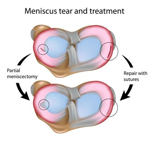 Partial Meniscectomy | Knee Surgeon | Minnesota
