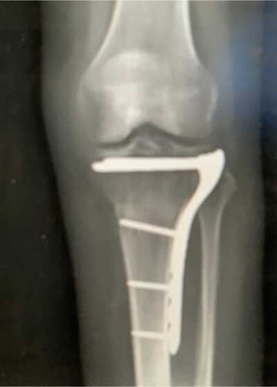 Tibial Plateau Fracture X-ray
