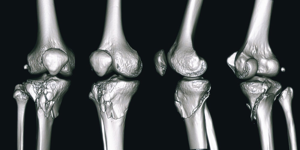 Medial tibial plateau depression fracture
