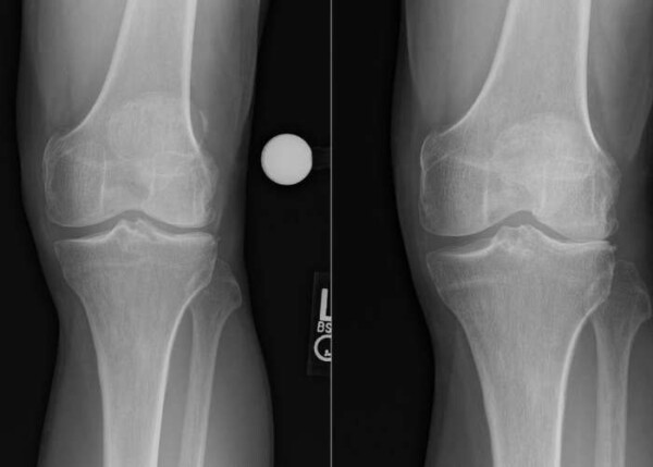 Lateral Meniscus Tear in Young Patient | MN
