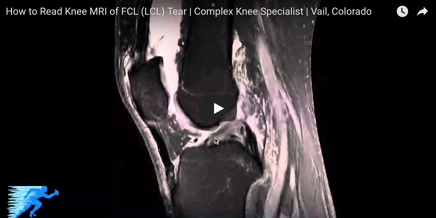LCL Injury, FCL, Lateral Collateral Ligament, Orthopedic Knee Specialist