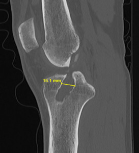 ACL Tibial Tunnel Osteolysis