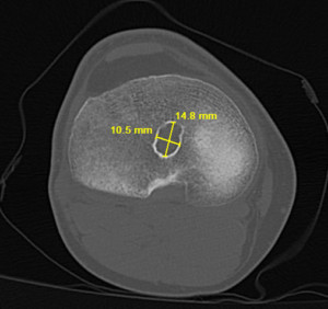 Posterior Malpositioned ACL Femoral Tunnel
