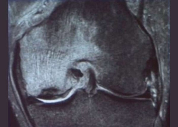 root tear with SONK and an insufficiency fracture in a left knee