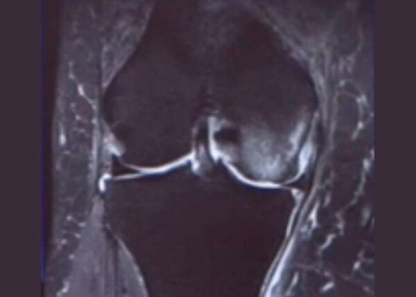 SONK and Meniscal Root Tear with L Knee Fracture