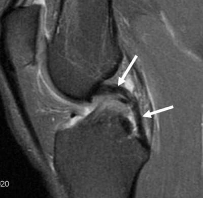 Chronic PCL Injury (intact)