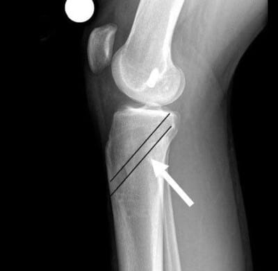 Lateral Knee with PCL Tunnel