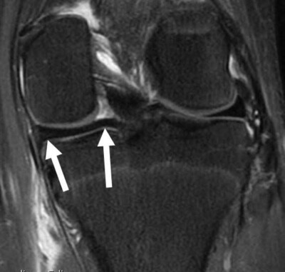 Coronal MRI of Normal Posterior Horn of Medial Meniscus