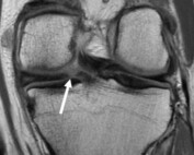 Medial Meniscus Root Tear