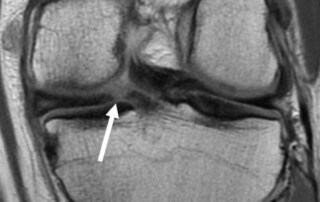 Medial Meniscus Root Tear