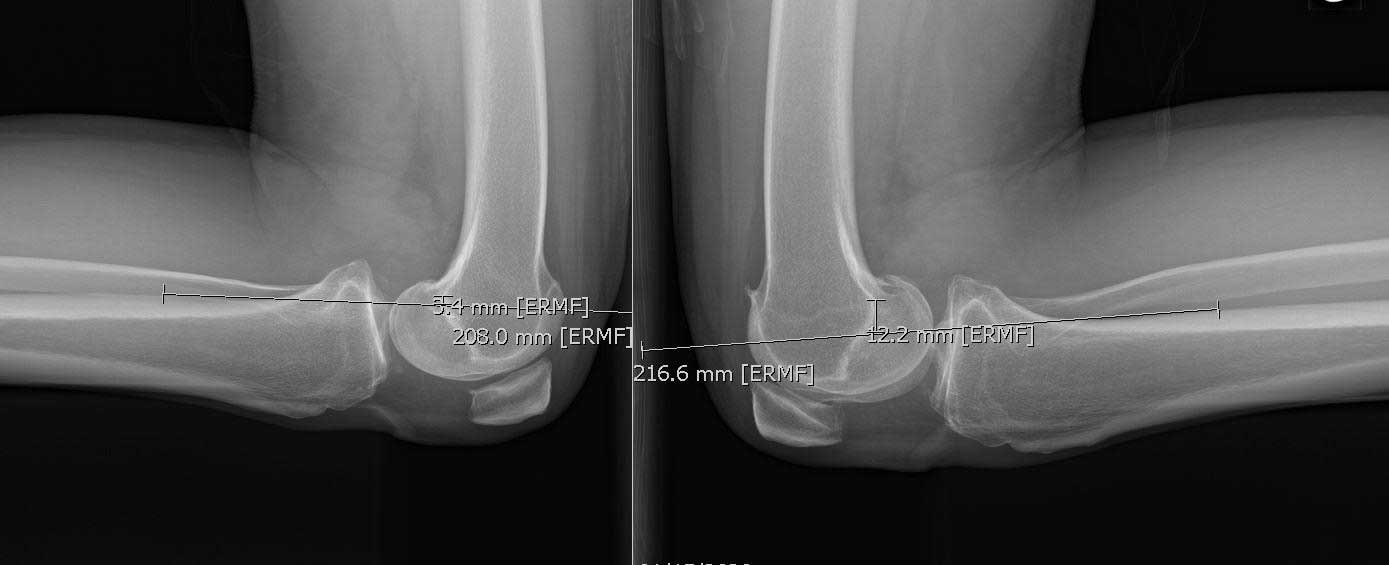 Pcl Injury Posterior Cruciate Ligament Tear Knee Specialist Minnesota