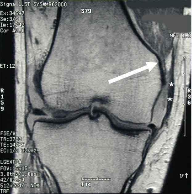 MCL Injury, Medial Collateral Ligament Tear