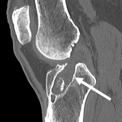 Large Tibial Tunnel on CT Scan for Failed ACLR