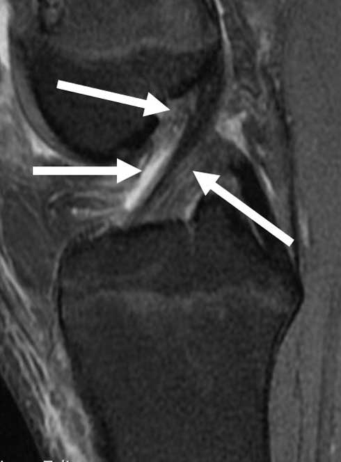Anterior cruciate ligament tear - complete, Radiology Case