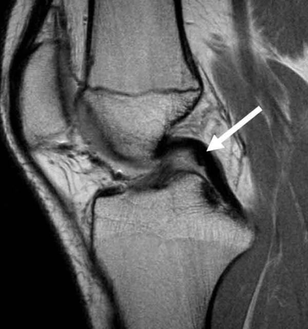 PCL Injury Posterior Cruciate Ligament Tear Knee Specialist Minnesota