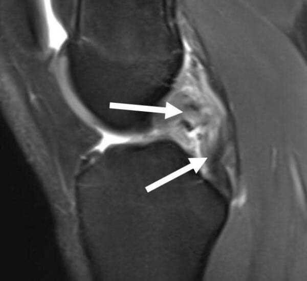 PCL Injury | Posterior Cruciate Ligament Tear | Knee Specialist | Minnesota