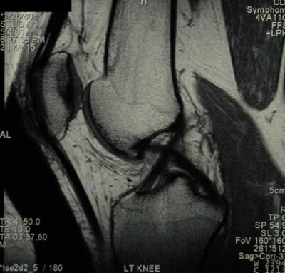 ACL-PCL Crossing in Cruciate Fashion