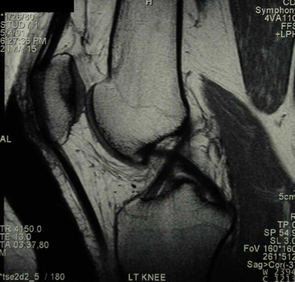 Multi-Ligament Knee Injuries | Complex Knee Specialist | Minnesota