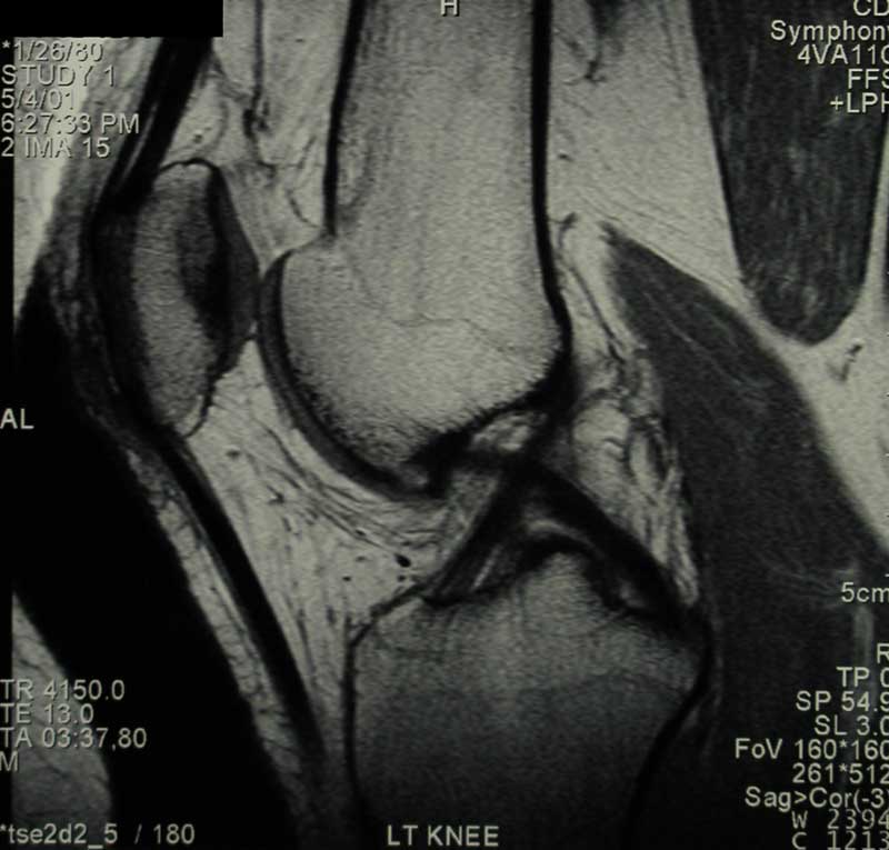 Multi-Ligament Knee Injuries, Complex Knee Specialist