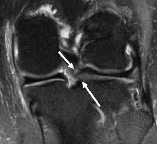 Macerated Degenerative Tear Of The Lateral Meniscus At Kathleen Campion 