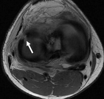Lateral Meniscus Radial Tear