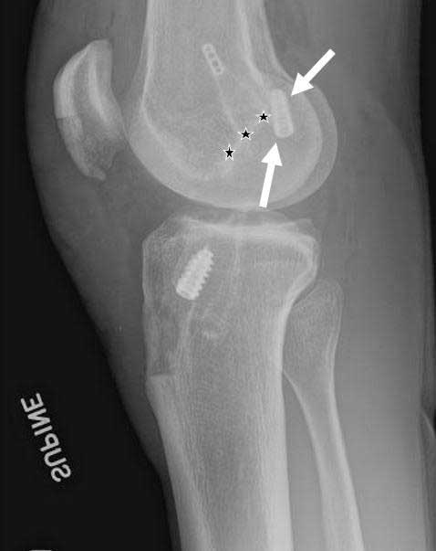 Lateral Knee X-ray of ACL Reconstruction Tunnels