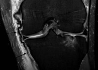 MCL Injury | Medial Collateral Ligament Tear | Complex Knee Specialist