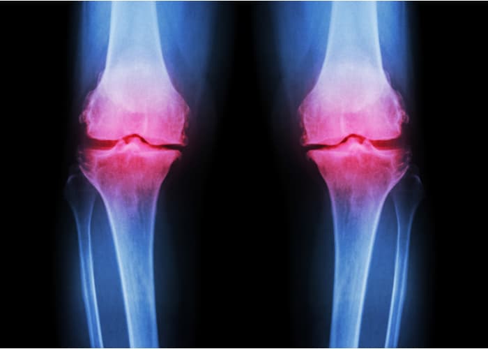 Osteoarthritis knee icd 10, Betegség megnevezésének szinonímái: