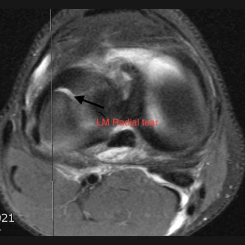 Lateral Meniscus Radial Tear shown in MRI
