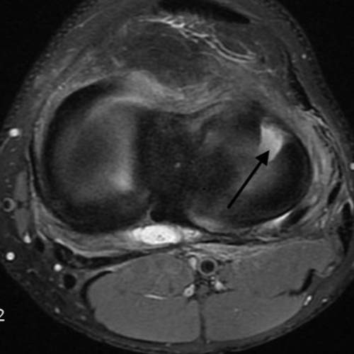 MRI Shows Anterolateral Radial Tear Left Knee